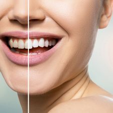 Is It Possible to Whiten Yellow Teeth?