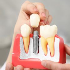 Dental Implants: a Long-Term Solution for Missing Teeth